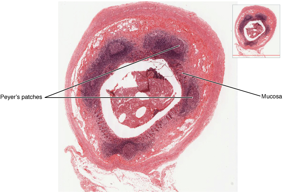 Mucousa associated lymphoid tissue nodule. Image description available.