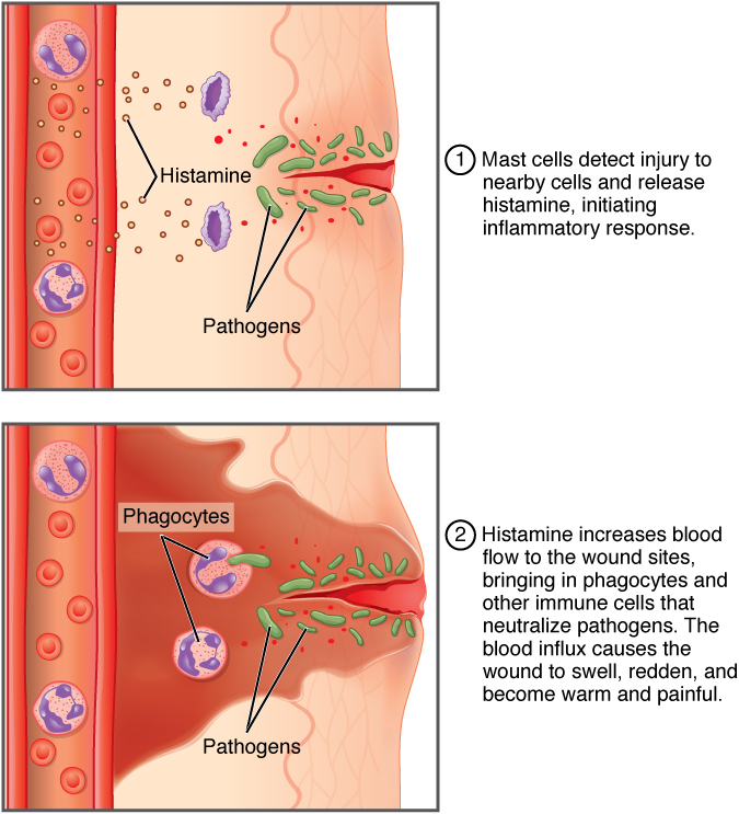 Inflammatory response. Stages of this response are detailed in the text below the figure.