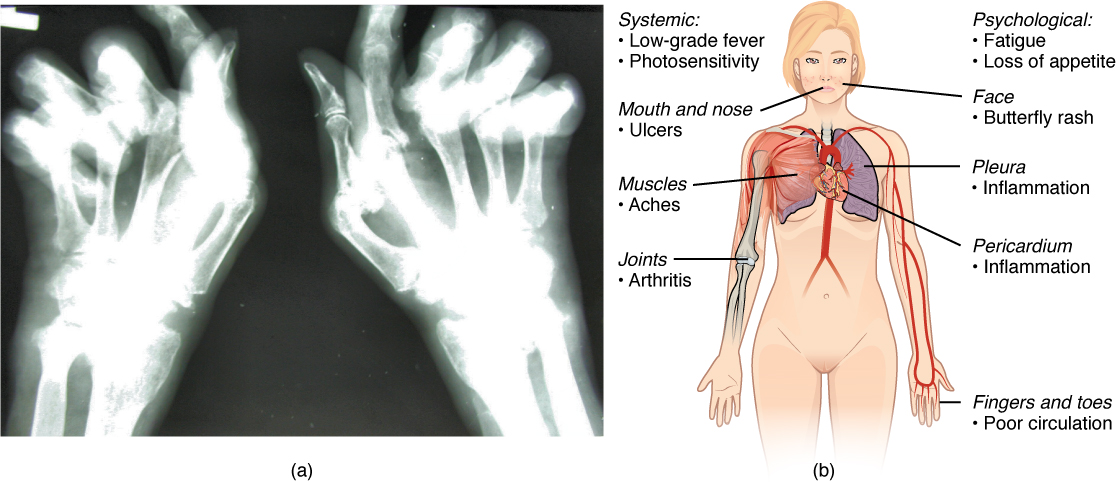 Rheumatoid arthritis xray and lupus symptoms.