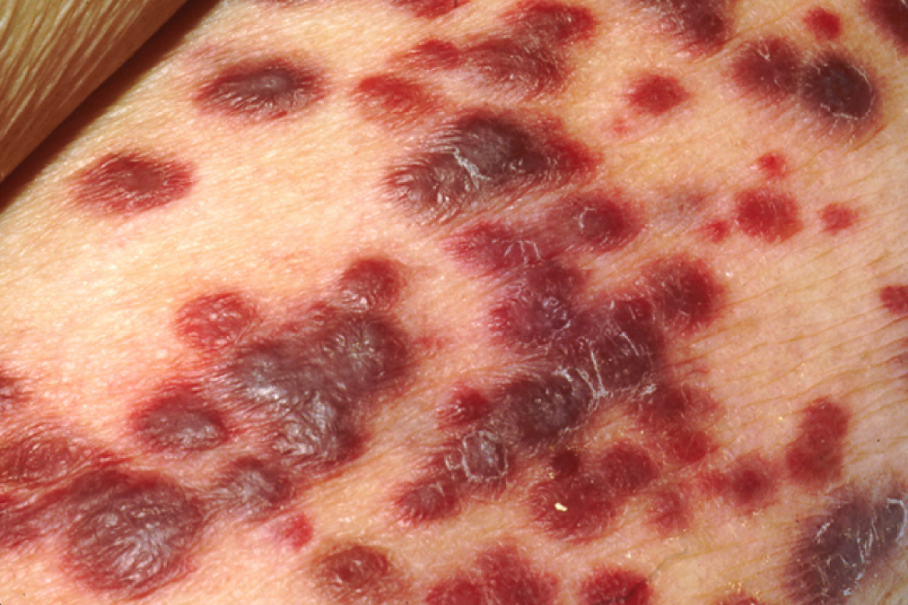 This photograph shows lesions on the surface of skin which are characteristic of Karposi's sarcoma.
