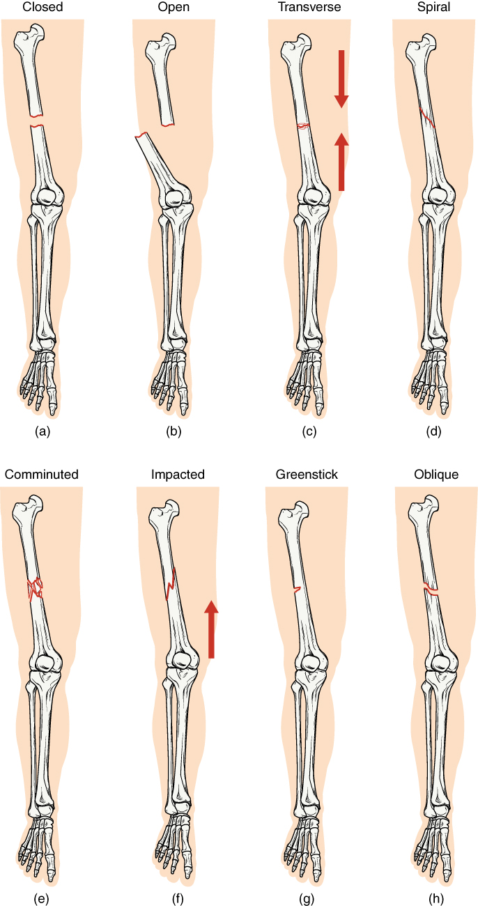 Types of fractures in the leg. Image description available.