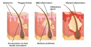 The three stages of acne plugged follicle, mild inflammation and marked inflammation