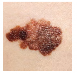 Image of a melanoma
