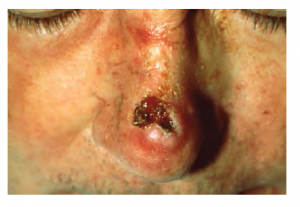 Image of squamous cell carcinoma on a person's nose